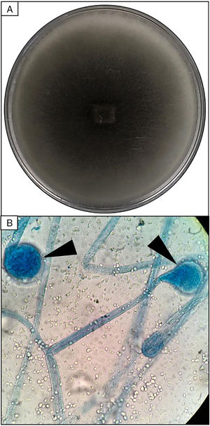 Skin biopsy culture. (A) Culture with dark-gray cottony colonies of Mucor spp., macroscopic morphology on Sabouraud Dextrose Agar. (B) Large spherical sporangia (arrowheads) and pronounced columellae with sporangiospores, in the absence of rhizoids (microscopic morphology on Lactophenol cotton blue stain, 100×).