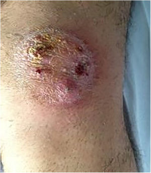 Lesión de bordes descamativos y sobreinfección en la rodilla izquierda.