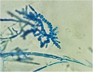 Cadenas de clamidoconidias características de T. verrucosum en el examen microscópico con azul de lactofenol (×40).