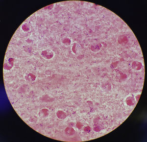 Tinción de Gram de esputo (1000x) donde se puede observar abundantes leucocitos y bacilos grampositivos de morfología Corynebacteriaceae.