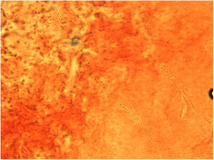 Skin scraping direct microscopic examination showing hyphae and thick-walled arthroconidia in formation (KOH mount, 60×).
