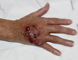 Placa eritematosa con nódulos violáceos coalescentes en el dorso de la mano derecha de la paciente, que coincidía con la zona en la que se había canalizado de forma traumática una vía periférica semanas antes.
