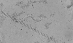 Larva rabditoide de Strongyloides stercoralis en heces. Examen en fresco MIF (mertiolato, yodo y formaldehído). 40x.