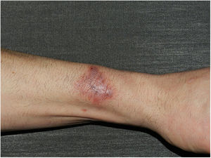 Placa eritematoviolácea infiltrada de bordes irregulares de 35 × 25 mm, con una úlcera central de 5 mm.