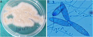 A: Colonias pulverulentas, planas y de color ante, que maduraron a los 7 días en medio agar Saboraud con cloranfenicol y gentamicina a 30 °C. B: Microconidias piriformes y macroconidias con forma de huso, extremos redondeados, equinuladas, pared fina y 4 a 6 septos, compatibles con Microsporum gypseum (examen microscópico con azul de lactofenol).
