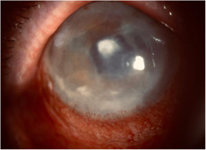 Leucoma central tras absceso y edema estromal y endotelial por queratopatía bullosa.