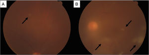 Funduscopic findings. (A) Dilated fundus examination revealed a white, rounded, small retinal lesion with well-defined borders in the superior temporal quadrant of the right eye (black arrow). (B) Left eye with vitreous haze and multiple vitreous condensations in the form of bands, extending from the optic nerve (black arrows); and a similar retinal lesion as the contralateral eye, in the superior temporal quadrant.