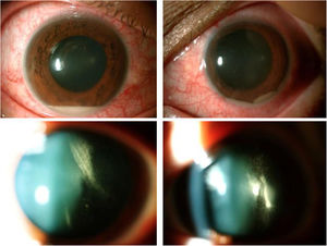 Forty-eight hours after onset of symptoms, bilateral hypopion (LE hypopion movement after AC tap) and dense vitritis. Visual acuity RE 20/100 LE Hand motion.