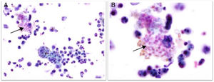 A, Acute inflammatory response intermixed with macrophagues to Microsporidia infection (Papanicolau stain; 40×). B, Microsporidia forms (Papanicolau stain; 100×).