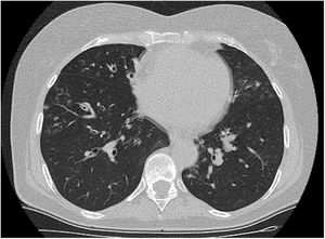 Corte de TC en el que se observan bronquiectasias e imágenes nodulares de predominio periférico en el lóbulo inferior derecho.