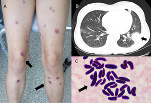 Hallazgos clínicos, radiológicos y microbiológicos. A. Lesiones en la piel tipo máculas violáceas y redondas en las extremidades inferiores. B. Tomografía computarizada de tórax: consolidación en el lóbulo superior izquierdo sin signo del halo y sin cavitación. C. Tinción de Gram de hemocultivos: estructuras redondas y ovales compatibles con macroconidias.