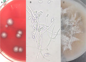 Hallazgos macroscópicos y microscópicos. A. Agar sangre: colonias peludas, planas, blancas y redondas. B. Preparación con KOH de la placa de agar sangre: se observan hifas septadas hialinas con ramificación en ángulo agudo y macroconidias. C. Agar avena: colonias de aspecto liso y algodonoso de color blanco grisáceo.