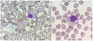Frotis de sangre periférica con tinción May-Grünwald Giemsa donde se observan numerosos bacilos. A gran aumento se observa un monocito con bacilos fagocitados en vacuolas.