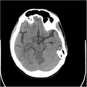 Thalamic infarction due to occlusion of the P2 segment of the right posterior cerebral artery. An ischemic infarction of the middle part of the cerebellum is also seen (territory of the superior cerebellar artery).