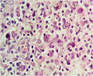 Excision biopsy showing Reed–Sternberg cells.