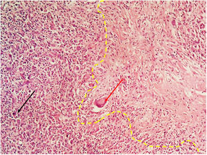 Lymph node biopsy showing caseating and necrotizing granulomatous lesions with Langhans’ giant cell (red arrow). Hodgkin's cell in the left (black arrow).