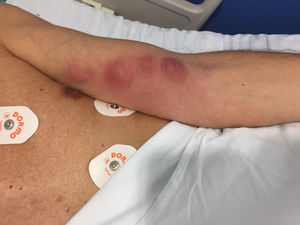 Lesiones abscesificadas siguiendo el trayecto de un vaso linfático en el brazo del paciente en el momento de su segundo ingreso.