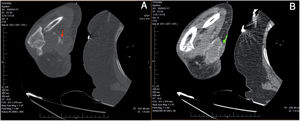 (A) Preoperative angio-CT: thrombosed arteriovenous fistula pointed with the red arrow. (B) Inflammatory changes in subcutaneous tissue around the fistula.