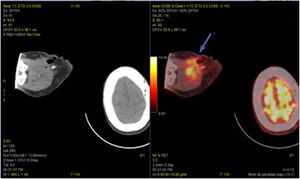Postoperative PET-scan showing hypercaptation of the muscular, subcutaneous and cutaneous layers of the right arm.