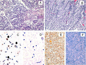 Histopathological and HHV-6A immunohistochemical studies in fetal tissues. The microscopic study by conventional hematoxylin and eosin stainings of the fetal lung (A) and brain (B) tissues did not reveal any histopathological finding. The immunohistochemical study for the HHV-6 late antigen gp116/64/54 showed positive cells in the brain (black arrows) (C). Representative image of HHV-6 negative brain control tissue incubated with protease negative control reagent (D) HSB2 cells infected with HHV-6A were used as a positive control (E). HHV-6 negative tonsil tissue was used as a negative control (F). Original magnifications: A and B: 200×; C, D and E: 400×.