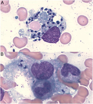 Intracellular Leishmania amastigotes in macrophages with hemophagocytic phenomena (A: erythrocytes, B: band neutrophil) in a bone marrow aspiration sample (Wright's stain, original magnification ×100).