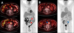 18F-FDG PET/CT showing: (A) Maximum intensity projection (MIP) and Axial-fused PET/CT images: two foci of high intensity FDG uptake in the aortic graft (SUVmax 17.79 and 9.46 respectively), consistent with infection of the graft (red arrows). (B) Same patient and same projections showing: significant decrease in FDG uptake after treatment (SUVmax 3.70 and 2.78 respectively) (blue arrows).