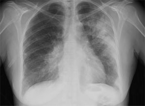 Radiografía de tórax al cuarto día de ingreso: progresión de la consolidación en pulmón izquierdo y perihiliar derecha. Pequeño derrame plural bilateral.