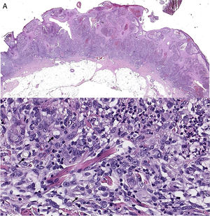 Biopsia cutánea de lesión del codo izquierdo, hematoxilina-eosina (H&E). A) Vista panorámica: hiperplasia escamosa seudoepiteliomatosa junto con abundante infiltrado inflamatorio. B) A mayor aumento, el componente inflamatorio es heterogéneo con abundantes histiocitos/macrófagos, y en proporción minoritaria mezcla de linfocitos y neutrófilos, junto a proliferación de vasos. Se identifican unas estructuras laminares y refringentes en citoplasmas de macrófagos (flechas).