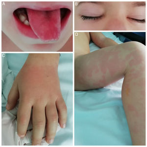 Manifestaciones cutáneo-mucosas: A) lengua aframbuesada; B) edema palpebral bilateral; C) eritema y edema en dorso de mano y D) exantema polimorfo en miembro inferior izquierdo.