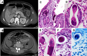 (A, B) Abdominal CT scan showing ascites in addition to small and large bowel wall thickening. (C–G) Duodenal biopsies showing S. stercoralis larvae and abundant eosinophils in the lamina propria (H & E [C–F] and PAS [G] stainings).