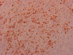 Inmunohistoquímica CD1a (×40). Refuerzo de kinetoplasto de amastigotes.