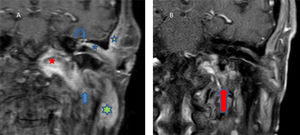 (A) Coronal T1 sequence, gadolinium. Thickening of the left external auditory canal (blue star) and soft tissues (orange star), parotid gland (green star), temporomandibular joint (straight arrow), occipital condyle (red star) and middle ear (curved arrow)]. (B) Similar section after 18m. Clear improvement, with disappearance of the occupation of the middle ear and decrease in the volume of the tissues originally affected. Unspecific enhancement at the jugular foramen (red arrow).