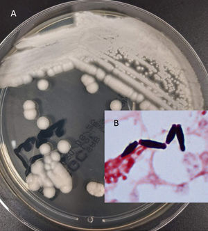 A. Morfología macroscópica de colonias de Geotrichum capitatum tras 48h de incubación en agar Sabouraud. B. Artroconidia en tinción de Gram a partir de frasco de hemocultivo (1.000x).