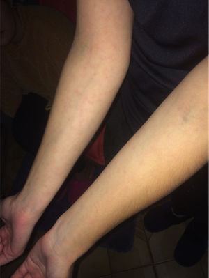 Lesiones cutáneas maculares violáceas en ambas extremidades superiores, sin compromiso palmar.