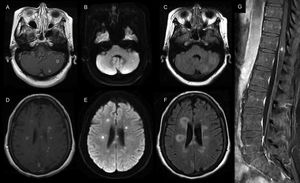 Brain and spine MRI. (A, D) Axial T1-weighted contrast-enhanced MRI shows multiple infra and supratentorial ring-enhancing lesions that were hyperintense on the (B, E) diffusion-weighted image (DWI) sequence with perilesional edema seen on the (C, F) fluid-attenuated inversion recovery (FLAIR) sequence. (G) Coronal T1-weighted contrast-enhanced MRI of the spine shows a contrast-enhancing lesion of the central spinal cord.