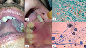 (A) Palatal ulcer in an uncontrolled diabetic patient. (B) Necrosis of the cheek lining and lingual in a patient with acute myeloid leukemia. (C) Necrotic lesion on the soft palate and onset of palatal ulcer. (D) Biopsy with multiple thick and coenocytic hyphae (Grocott, 40×). (E) Rhizopus arrhizus (cotton blue 10×).