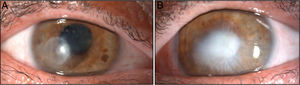 A) En el ojo derecho se aprecia un leucoma corneal paracentral temporal y la presencia de sinequias pupilares posteriores. B) En el ojo izquierdo destaca la presencia de un leucoma central con signos de neovascularización.