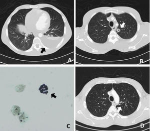 (A, B) Computed tomography scan showing a thick-walled cavitated nodule in the left superior lobe with ipsilateral pleural effusion. (C) Cryptococcus neoformans in bronchoalveolar lavage (silver staining, 600×). (D) Computed tomography scan showing a thin-walled cavitated lesion in the apical posterior segment with bronchial communication; no pleural effusion was found.