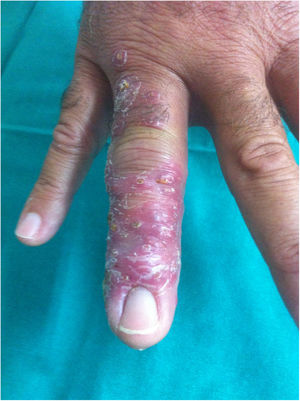 Lesiones en el cuarto dedo de la mano derecha, 8 semanas después de la punción.