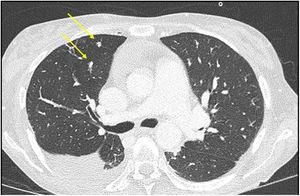 Tomografía axial computarizada torácica: múltiples micronódulos pulmonares bilaterales de probable carácter infeccioso.