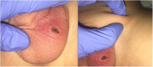 Piel del escroto del testículo izquierdo con eritema y una lesión costrosa negra con linfangitis y una adenopatía inguinal ipsilateral.