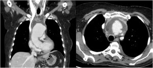 Secciones torácicas coronal (izquierda) y transversal (derecha) en las que se aprecia dilatación aneurismática de aorta ascendente rodeada de colección hipodensa que asciende hasta raíz de troncos supraaórticos.