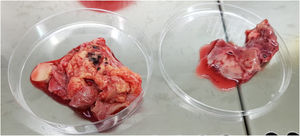 Pieza quirúrgica de aorta ascendente y cayado en la que se aprecia necrosis y desestructuración del vaso.