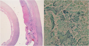 A la izquierda, preparación de hematoxilina-eosina de pared de aorta en la que se observa necrosis periadventicial e infiltrado inflamatorio denso. A la derecha, tinción de Grocott, con presencia de estructuras baciliformes pleomórficas filamentosas con uno de los extremos ovalados.