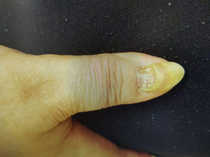 Lesión del lecho ungueal en zona proximal del primer dedo de la mano derecha.