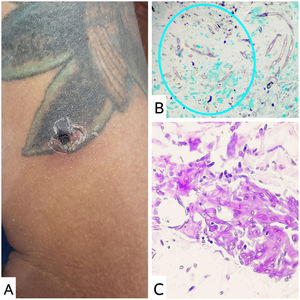 A) Lesión nodular en el brazo izquierdo sobre tatuaje. B) Tinción de Gomori, ×40: hifas hialinas, delgadas y septadas. C) Tinción de PAS, ×40: múltiples figuras micóticas.