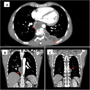 Tomografía axial computarizada (TAC) con contraste intravenoso. A) Colecciones paraaórtica y paravertebral-subpleural izquierda con erosión del cuerpo vertebral, proyección transversal. B) Colección paraaórtica, proyección longitudinal. C) Colección paravertebral izquierda, proyección longitudinal.