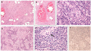 Ganglios linfáticos con linfoadenitis necrosante: necrosis isquémica con vasculitis necrosante (A), vasos periganglionares con trombo rojo (B), hiperplasia folicular con reacción inmunoblástica (C), plasmocitosis e histiocitosis sinusal (D). Presencia de ocasionales microgranulomas (E) (flecha). Inmunohistoquímica positiva para SARS-CoV-2 (F).