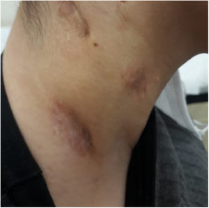 Complete recovery of the swelling after steroid treatment.