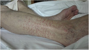 Patient 2: Mild vasculitis lesions in distal legs after CCP transfusion.